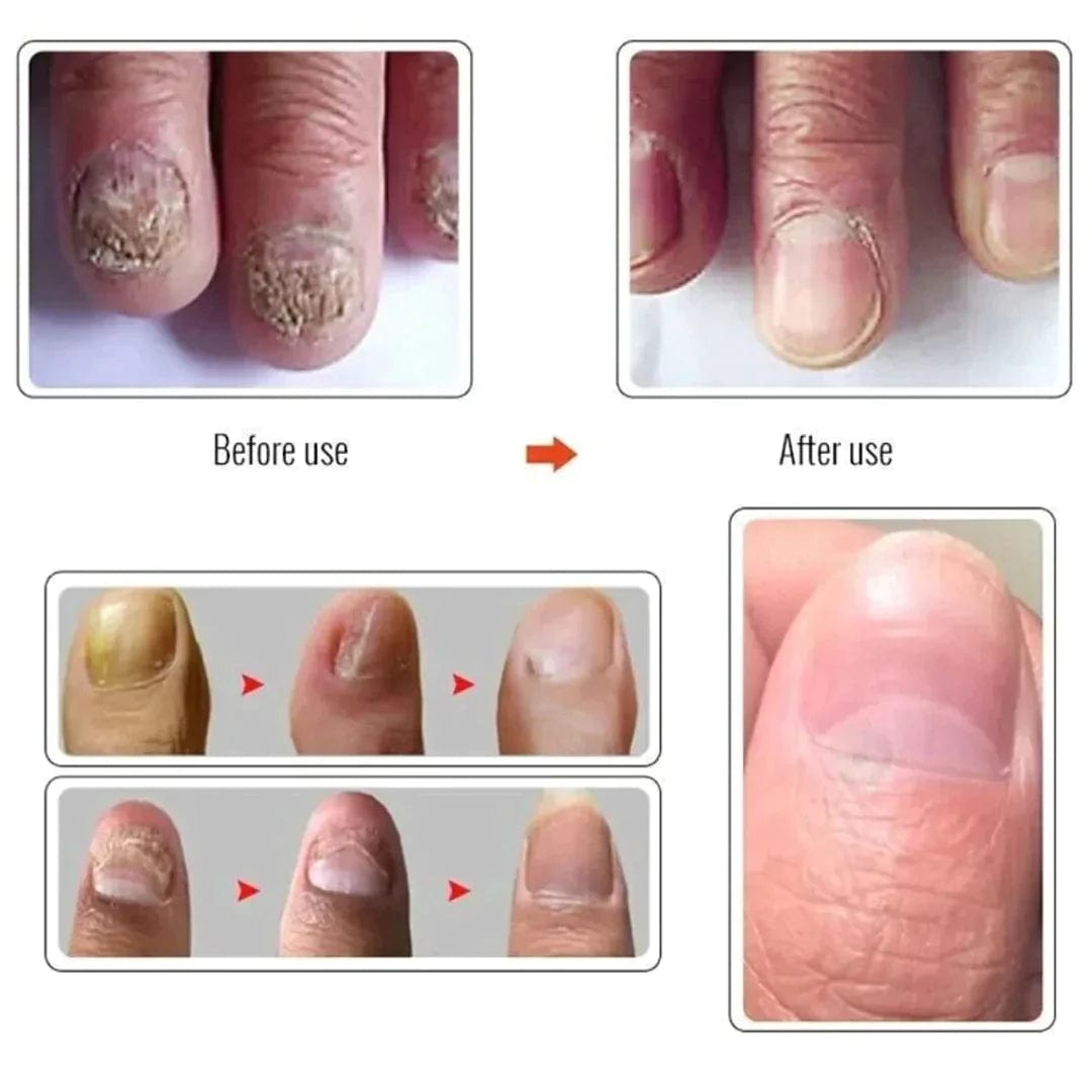 THE NAILS SERUM FOR NAIL GROWTH & REPAIR, FUNGAL INFECTION, ANTI-INFECTIVE REMOVAL PARONYCHIA ONYCHOMYCOSIS Roposo Clout