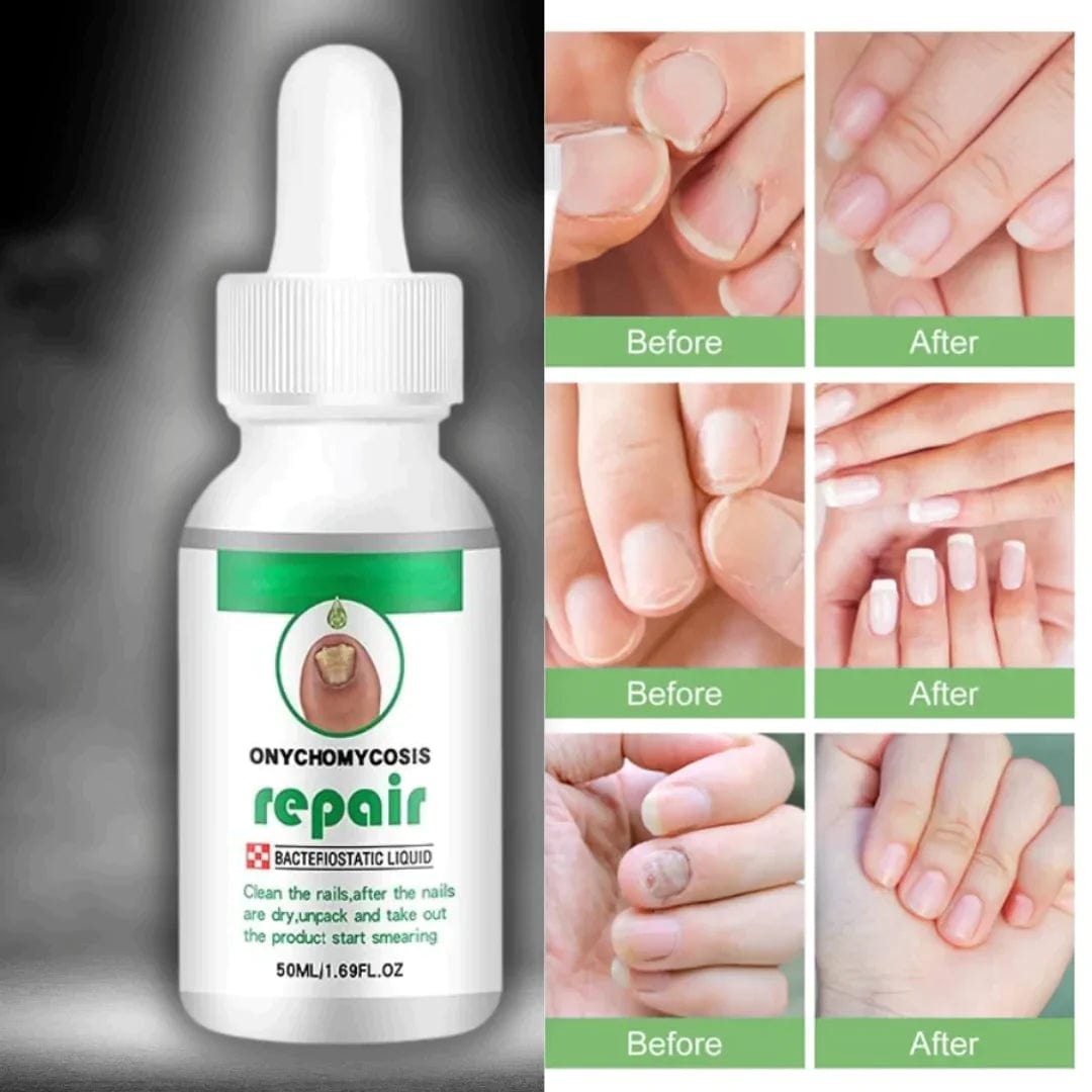 THE NAILS SERUM FOR NAIL GROWTH & REPAIR, FUNGAL INFECTION, ANTI-INFECTIVE REMOVAL PARONYCHIA ONYCHOMYCOSIS Roposo Clout